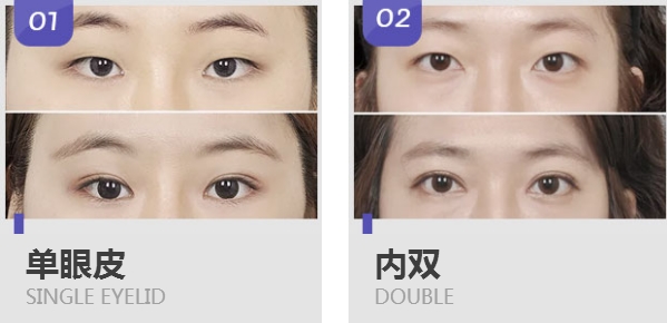 上海双眼皮手术价格表