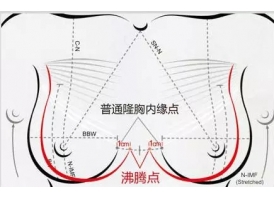 假体隆胸的柔软度怎么样