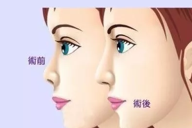 鼻子做假体能维持多久
