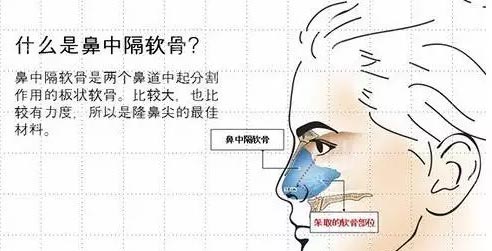 上海鼻中隔整形手术效果怎么样