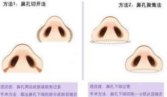 上海做鼻翼缩小手术多少钱