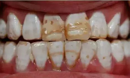 牙周病需要定期洗牙