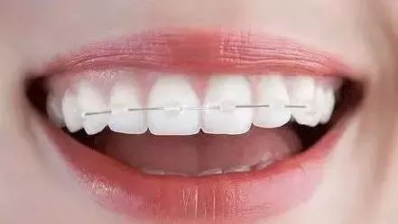 牙齿矫正可不可以只做半口