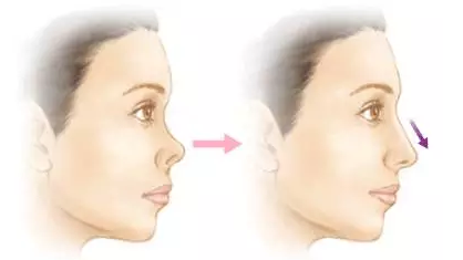什么是鼻中隔延长术