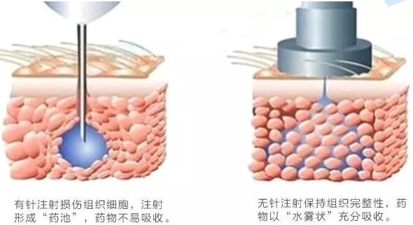 无针注射水光的效果