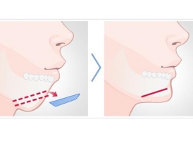 下巴后缩可以选择牙齿矫正来改善