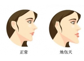 脸部角整形手术方法有哪些