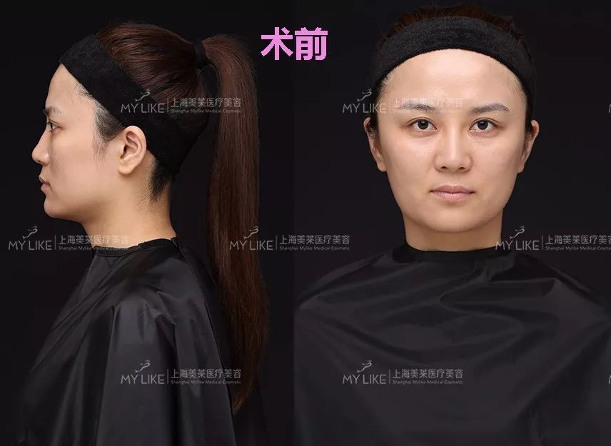 上海美莱玻尿酸全都部注射，打造V脸气质美女