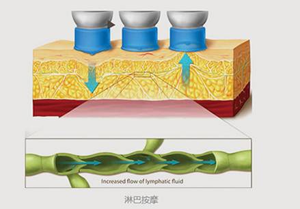 美莱超声吸脂瘦身原理