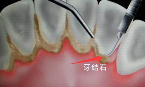 上海美莱洗牙