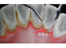 洗牙有什么好处，会不会伤害牙齿