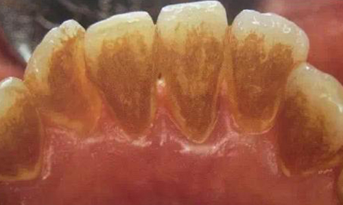 经常洗牙对牙齿好吗，会不会伤害牙齿
