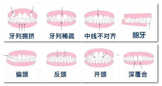 牙齿矫正方式有几种，哪种好