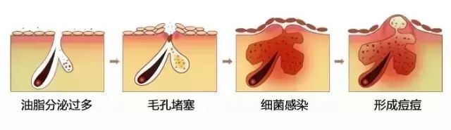 脸上很多痘痘怎么办，化学酸可以祛痘吗