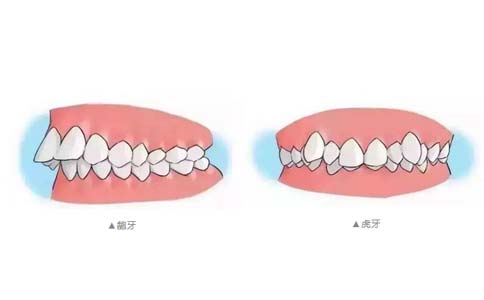 上海美莱暑期"美齿奖学金"，快来做牙齿矫正吧