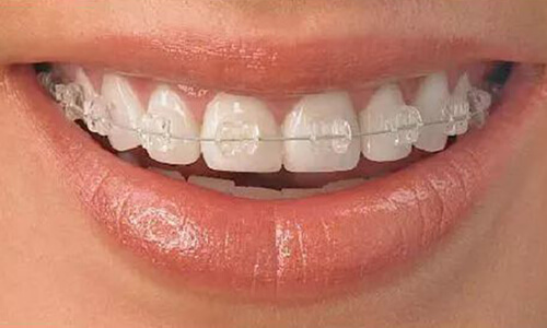 牙齿矫正有哪些方法，矫正过程是怎么样的