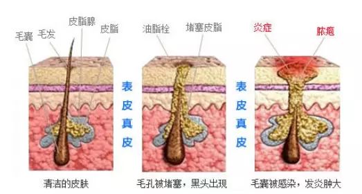 快速祛痘简单又有效的方法