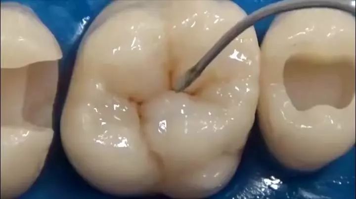 牙齿坏了需要补牙，过程是怎样的