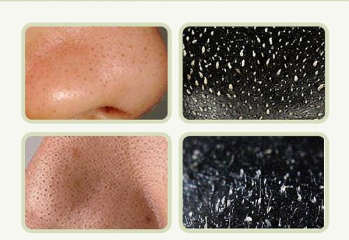 皮肤清洁真的可以改善毛孔粗大和黑头吗