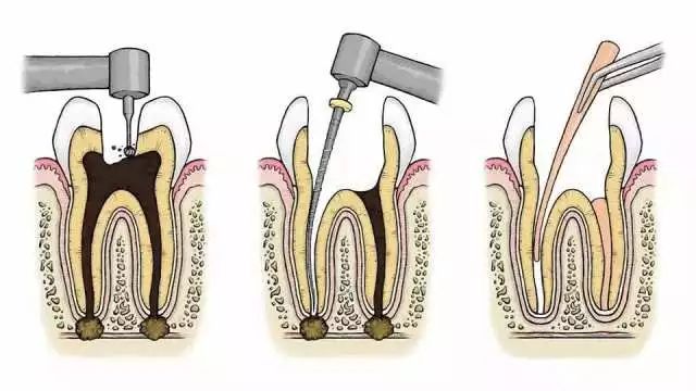 牙齿做根管治疗分几个步骤