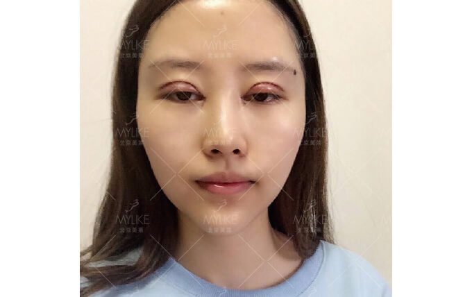 李菲儿综合美眼整形+北京双眼皮手术案例