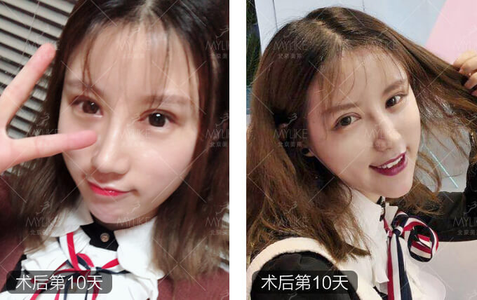 李莉倩双眼皮修复+北京美莱眼部案例