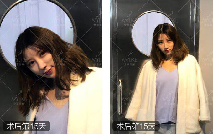 李莉倩双眼皮修复+北京美莱眼部案例