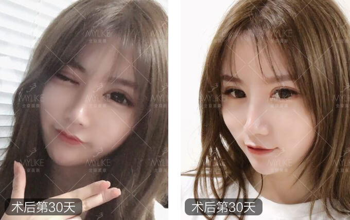 李莉倩双眼皮修复+北京美莱眼部案例