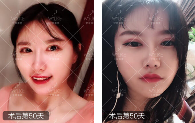 李莉倩双眼皮修复+北京美莱眼部案例