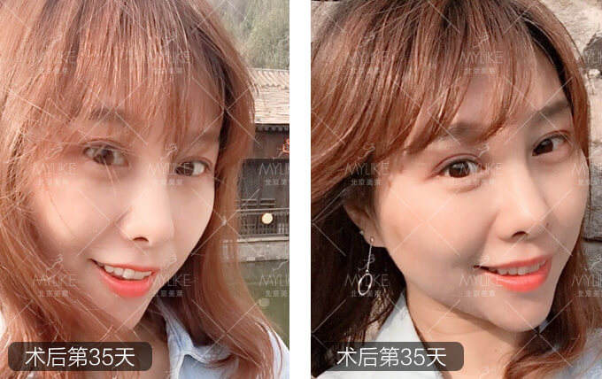 痒痒鱼眼部综合整形+北京美莱双眼皮案例