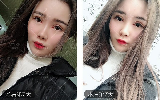 刘奕宁双眼皮整形+美莱眼部整形案例