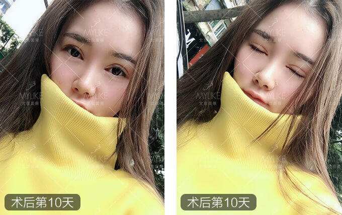 刘奕宁双眼皮整形+美莱眼部整形案例