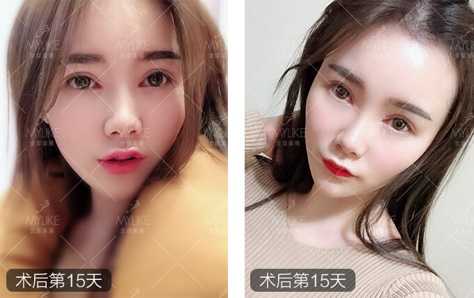 刘奕宁双眼皮整形+美莱眼部整形案例