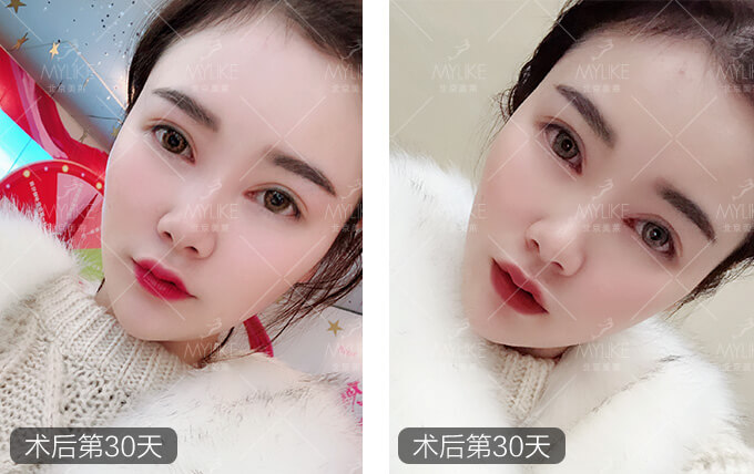 刘奕宁双眼皮整形+美莱眼部整形案例