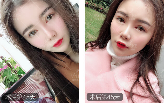 刘奕宁双眼皮整形+美莱眼部整形案例