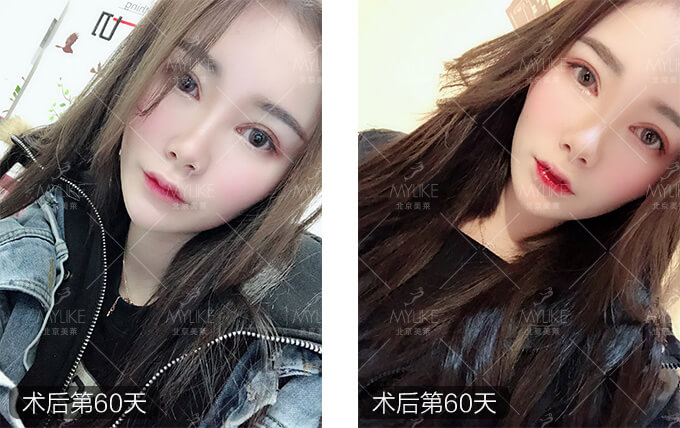 刘奕宁双眼皮整形+美莱眼部整形案例