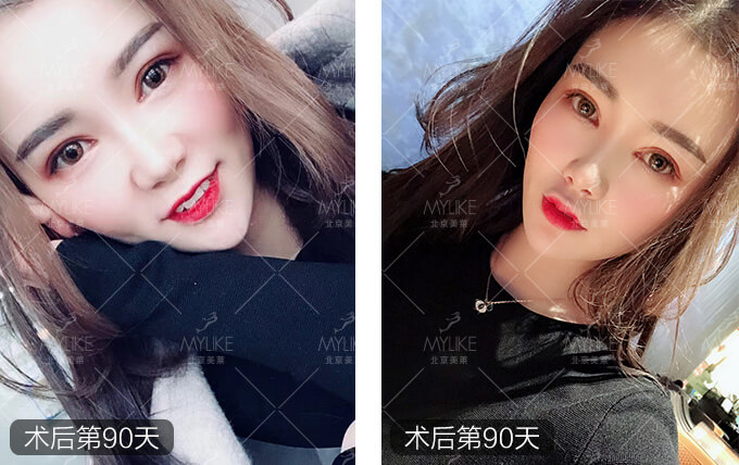 刘奕宁双眼皮整形+美莱眼部整形案例