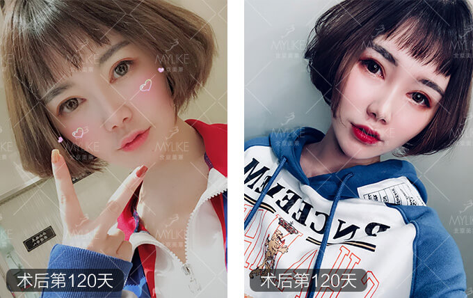 刘奕宁双眼皮整形+美莱眼部整形案例