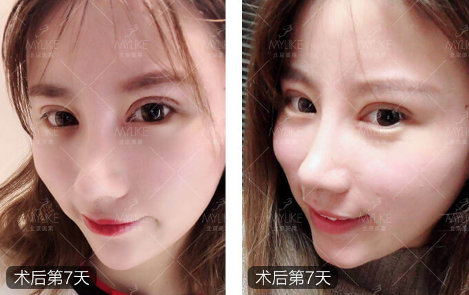李莉倩鼻综合整形+北京美莱鼻部案例