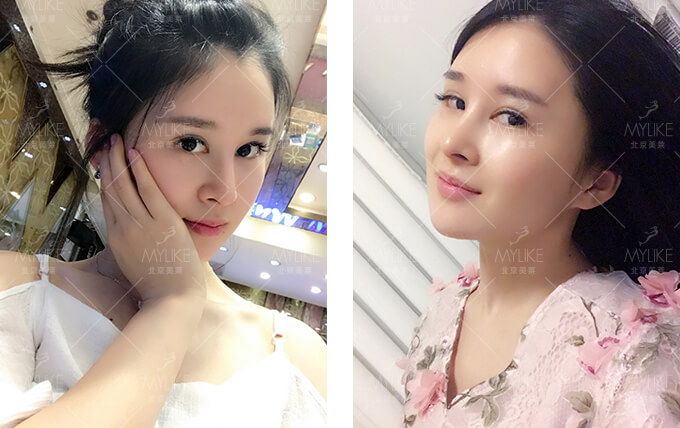 Monica鼻综合整形+北京美莱鼻部案例