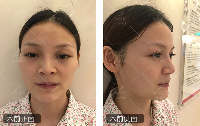 可待因儿假体隆鼻修复+北京美莱鼻整形案例
