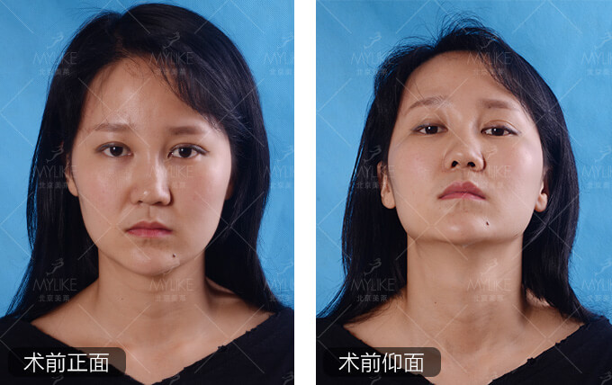 Allison自体软骨隆鼻+北京美莱隆鼻案例