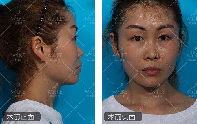 周娟综合隆鼻手术+北京美莱鼻部案例
