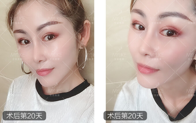 周娟综合隆鼻手术+北京美莱鼻部案例