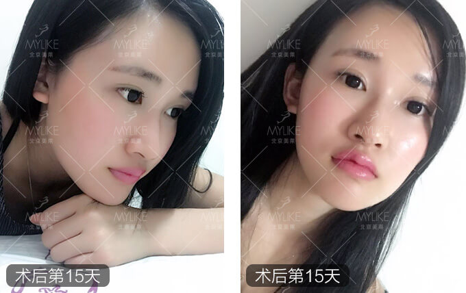 李莉玻尿酸注射隆鼻+北京美莱鼻部案例