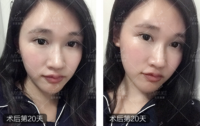 李莉玻尿酸注射隆鼻+北京美莱鼻部案例