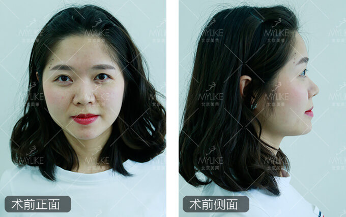 河清丹注射隆鼻整形+北京美莱鼻整形案例