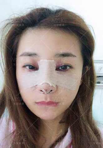 娜娜综合美鼻整形+美莱隆鼻手术案例