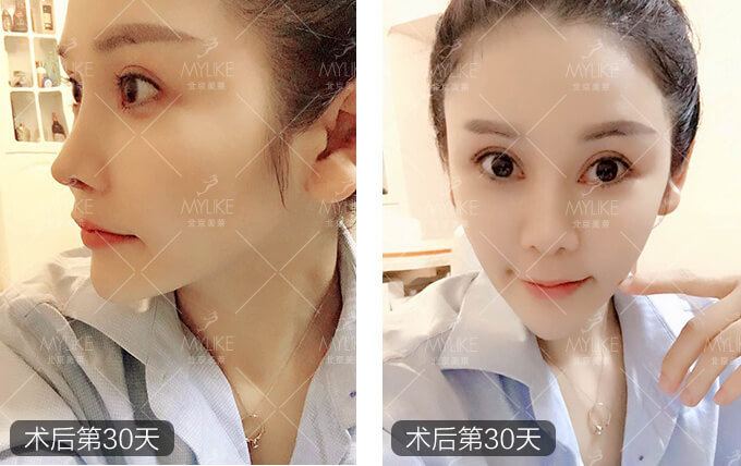柳儿综合隆鼻+北京美莱鼻部案例