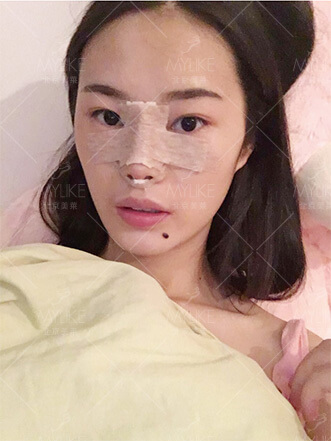 李火火隆鼻整形手术+北京美莱隆鼻案例
